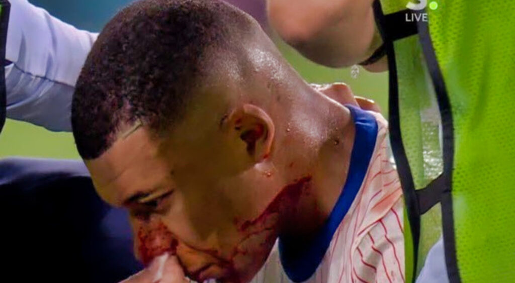 Kylian Mbappe with a bloody face