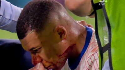 Kylian Mbappe with a bloody face