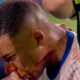 Kylian Mbappe with a bloody face