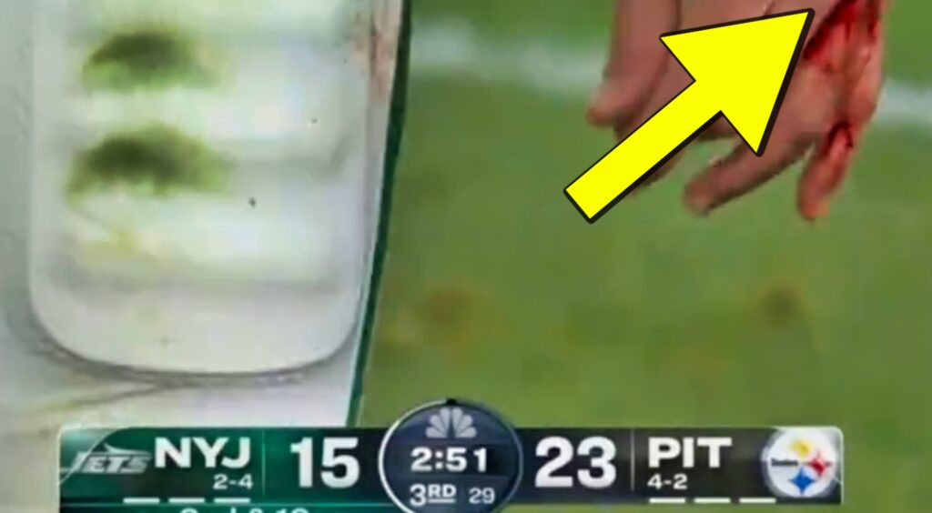 Aaron Rodgers' bloody hand.