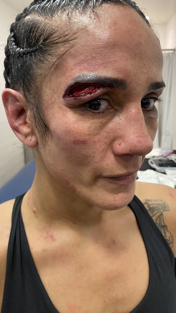 Amanda Serrano showing off a cut above her eye