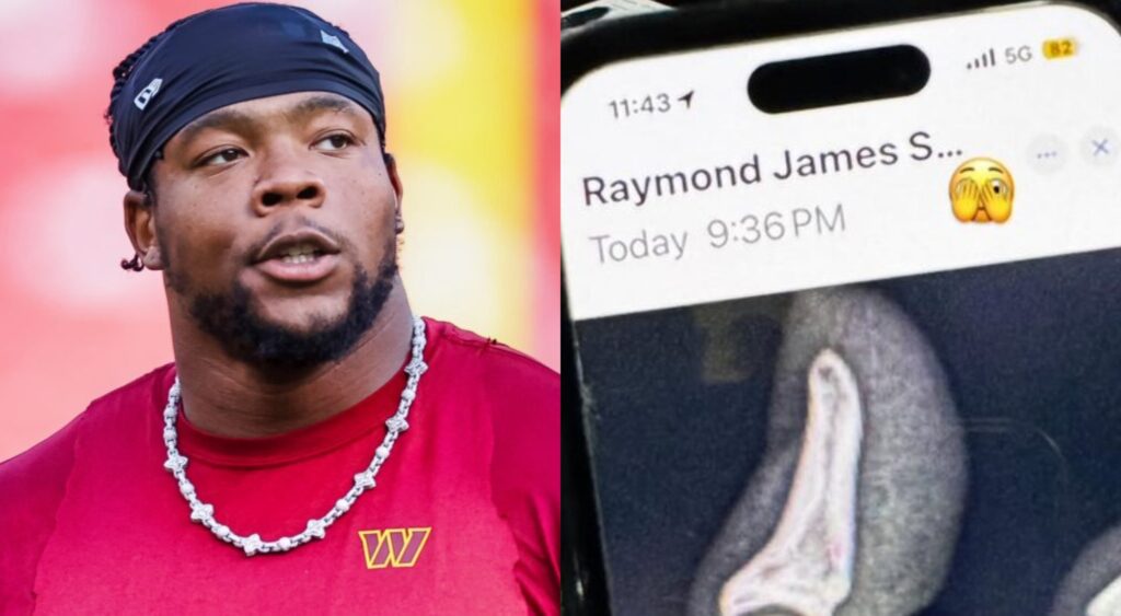 Daron Payne and his broken finger x-ray.